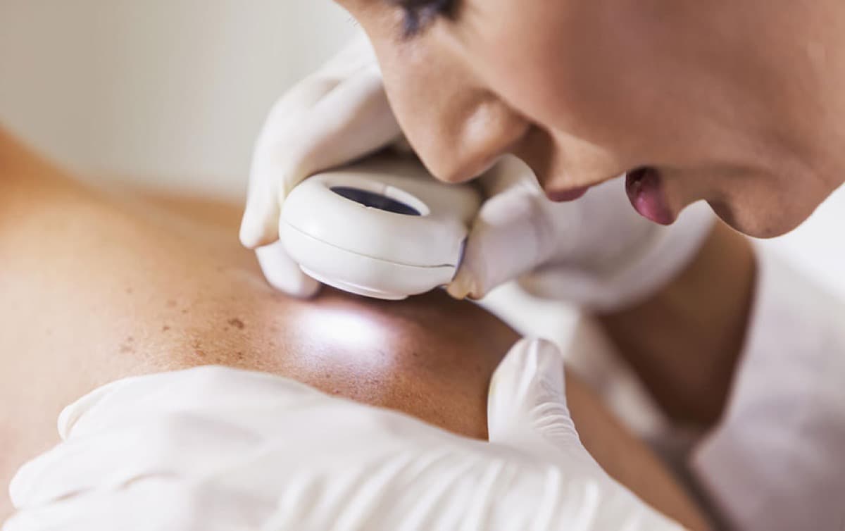 Diagnosi dermatoscopica