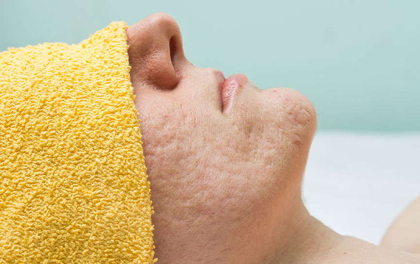 rimozione cicatrici dell'acne, trattamento acne